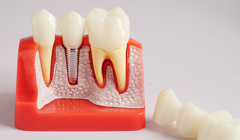 dental implant shown on fake gums